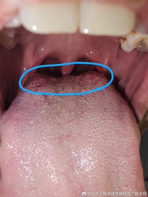 舌根起泡是口腔溃疡吗？怎么快速好？