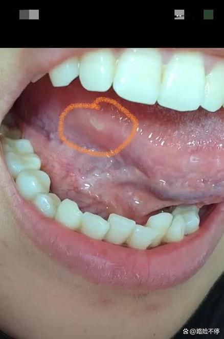 舌根起泡是口腔溃疡吗?怎么快速好?