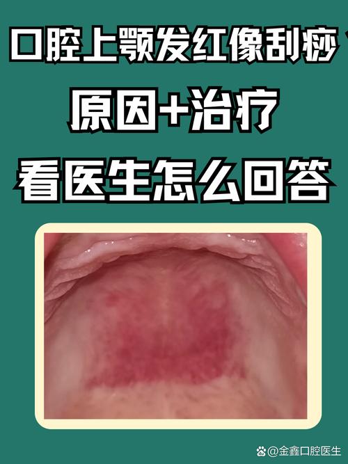 口腔上颚出血,是口腔疾病还是身体问题?