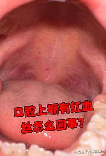 口腔上颚出血，是口腔疾病还是身体问题？