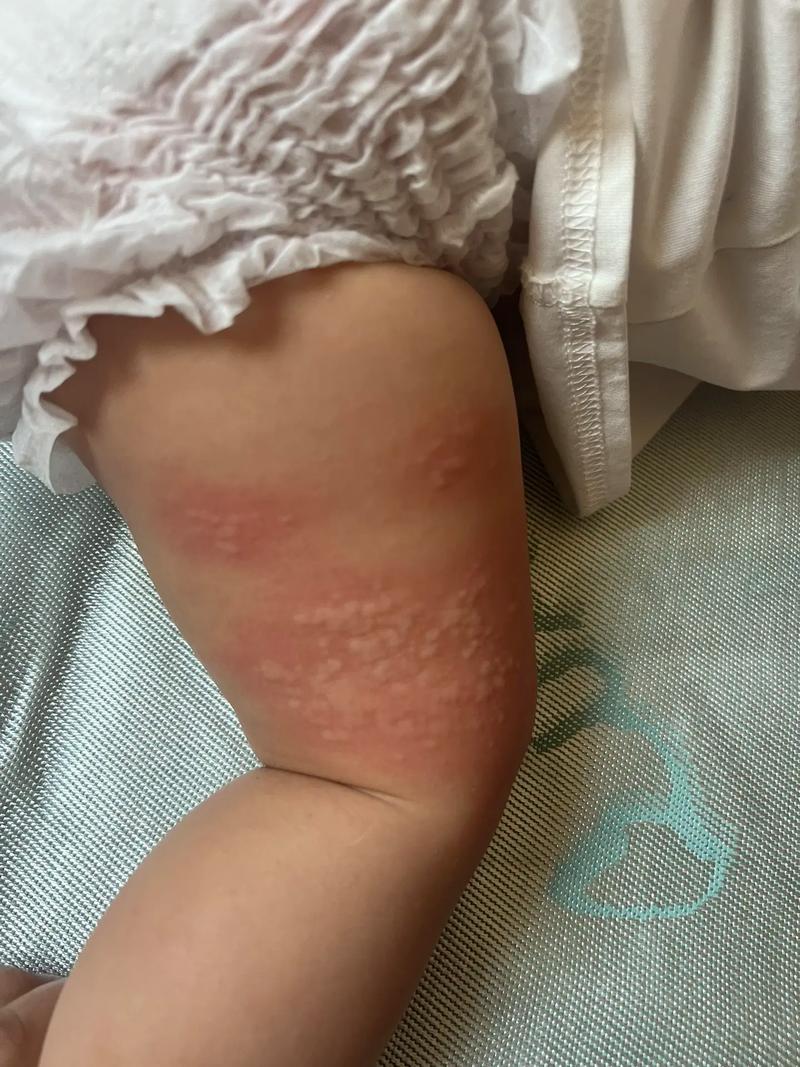 小孩皮肤过敏图片大全能直接判断过敏原因吗？