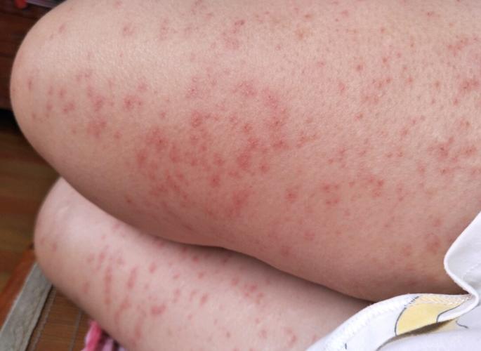 小孩皮肤过敏图片大全能直接判断过敏原因吗?