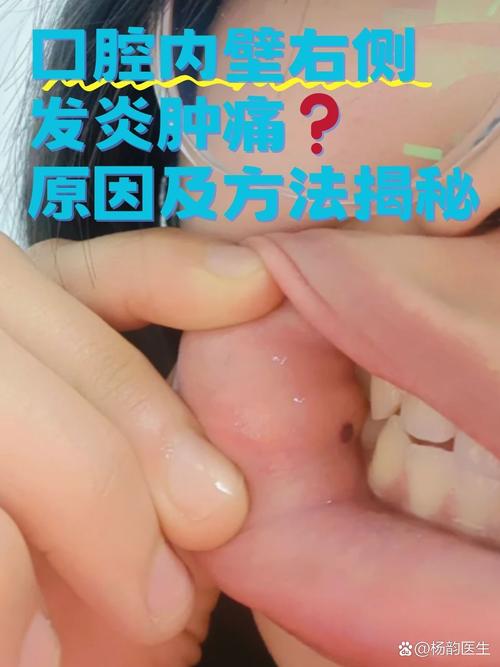 口腔脓肿究竟是如何引起的?