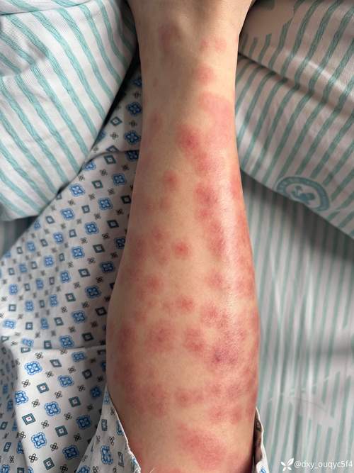 血燥热致皮肤瘙痒，如何有效缓解？