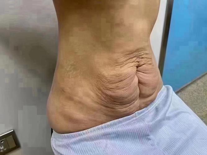 减肥后皮肤松弛怎么办?