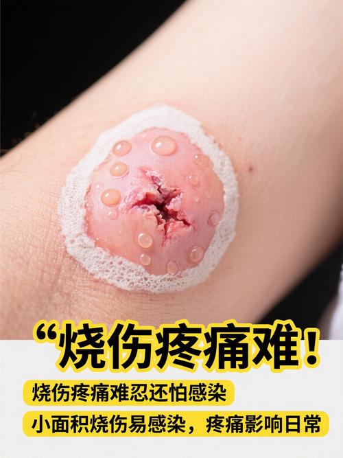 水泥烧伤皮肤,外用药选什么?