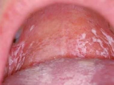 口腔白色膜状物是何原因?