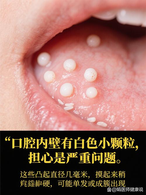 口腔白色膜状物是何原因?