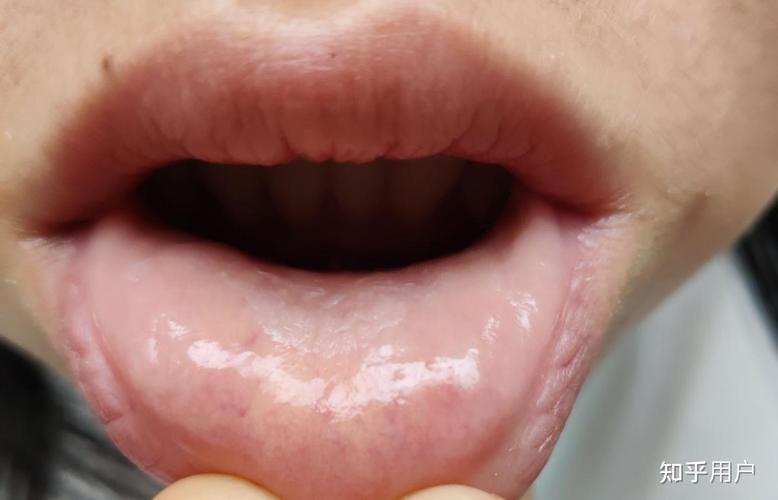 口腔白色膜状物是何原因？