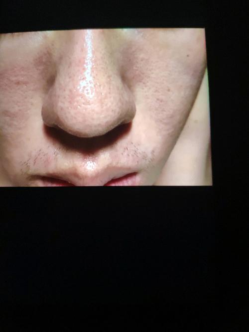 毛孔黑头是何物?如何清除?