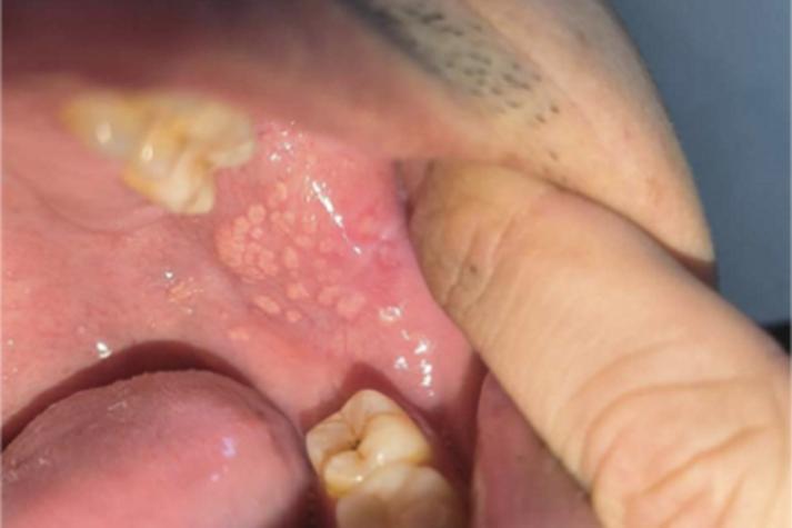 口腔内颊侧小疙瘩是何问题？