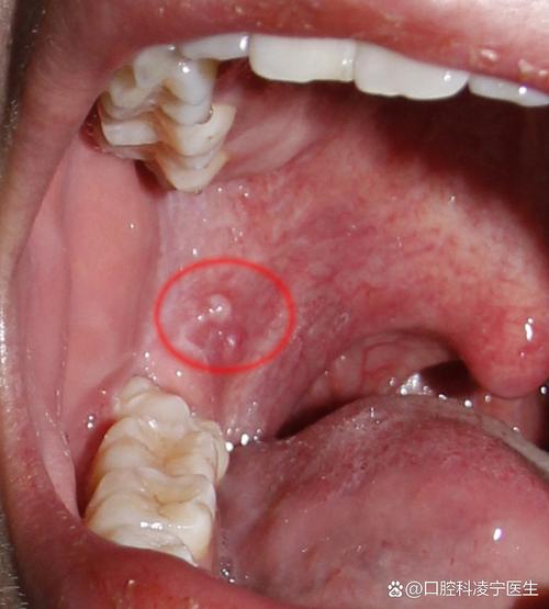 口腔内颊侧小疙瘩是何问题?