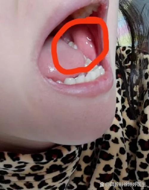 口腔内颊侧小疙瘩是何问题?