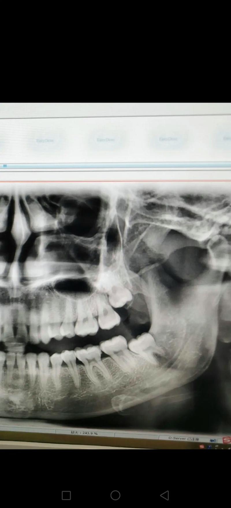口腔CT和全景片,检查范围与精度有何不同?