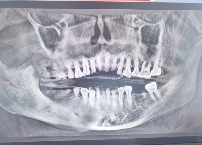 口腔CT和全景片,检查范围与精度有何不同?