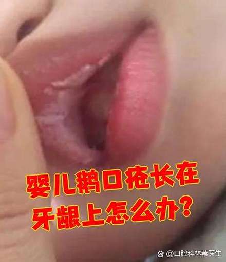 婴儿口腔白色奶块是鹅口疮还是正常现象?