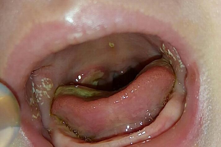 婴儿口腔白色奶块是鹅口疮还是正常现象？