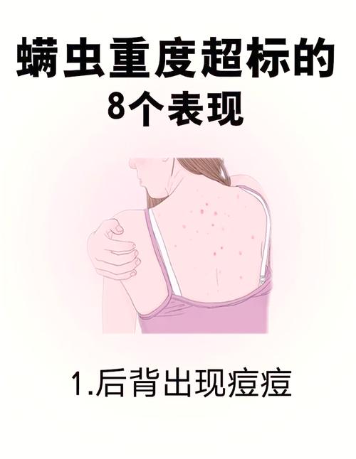 皮肤瘙痒是螨虫引起的吗?