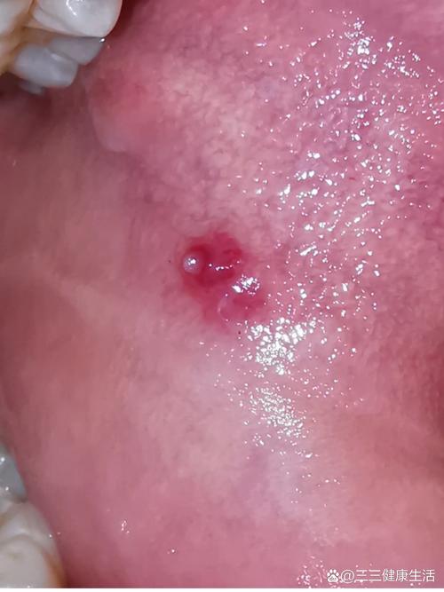 口腔上颚无痛硬块是何问题?