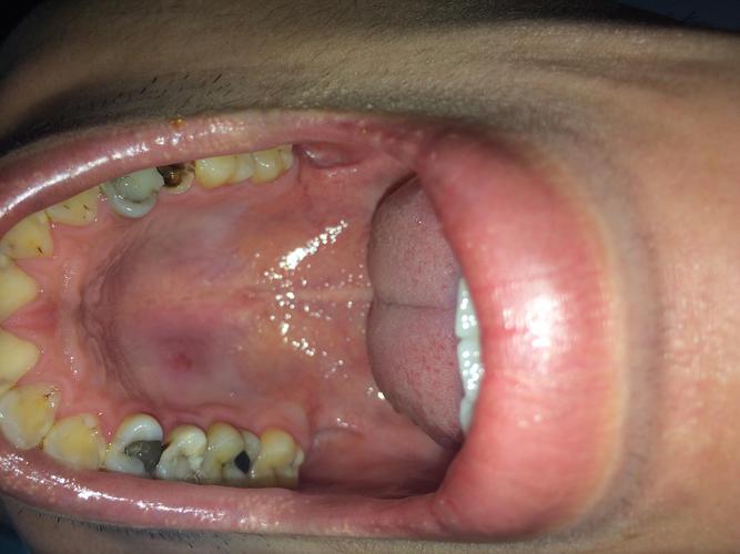 口腔上颚无痛硬块是何问题？