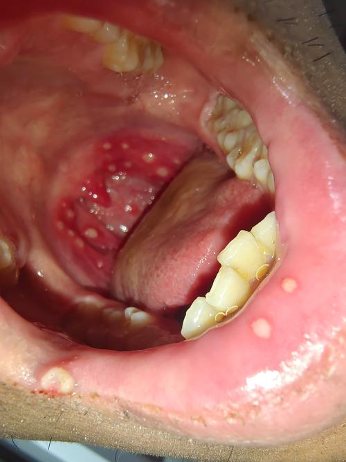 口腔溃疡白色上有红点是恶化信号吗?
