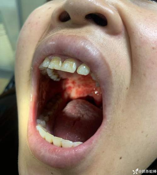 口腔溃疡白色上有红点是恶化信号吗？