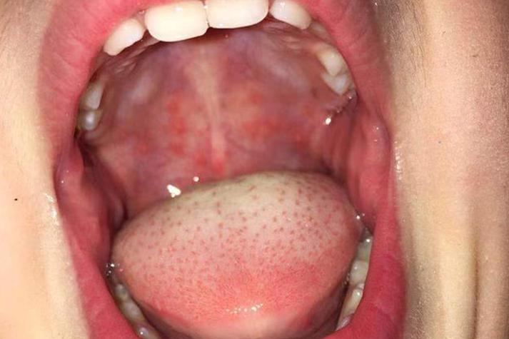 口腔溃疡白色上有红点是恶化信号吗?