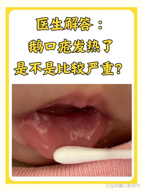 宝宝鹅口腔有哪些症状？