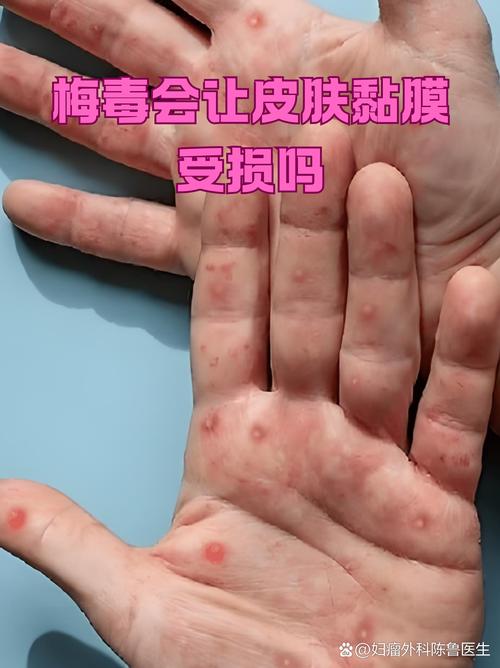 皮肤黏膜破损如何快速判断?