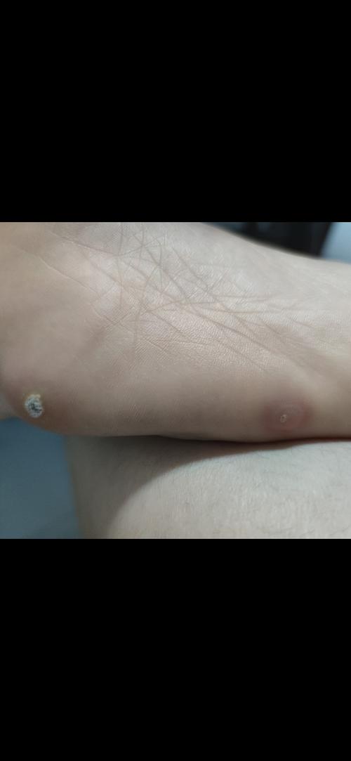 口腔内黑色血泡是何原因?