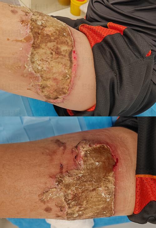 高锰酸钾烧伤皮肤图片如何应急处理？