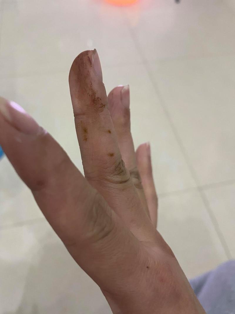 高锰酸钾烧伤皮肤图片如何应急处理?