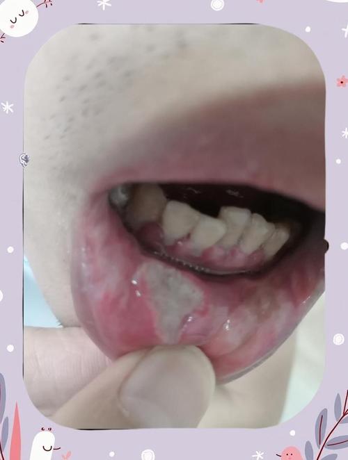 牙龈根部口腔溃疡为何频发难愈?