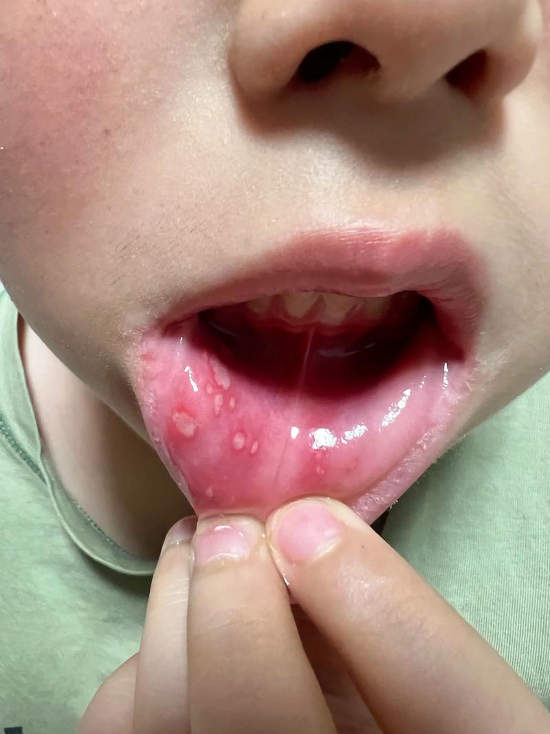 益生菌能治口腔溃疡吗?