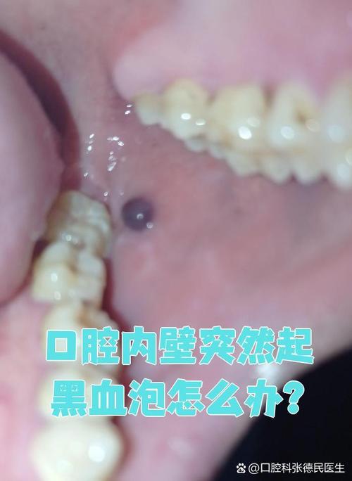 口腔为何反复起血泡？