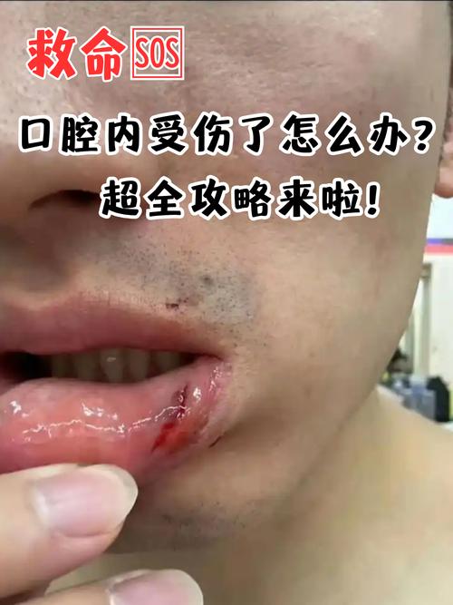 口腔内壁出血怎么办?