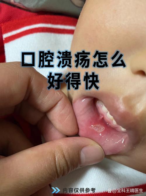 盐水漱口真能护口腔?好处与争议揭秘