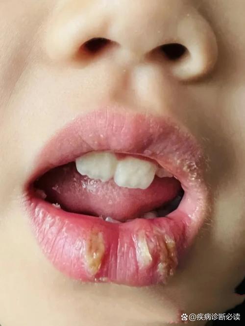 小孩满嘴口腔溃疡发烧是何原因?