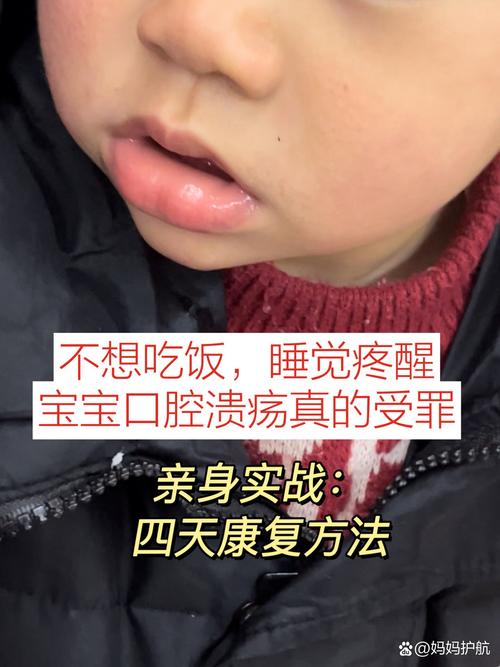 小孩满嘴口腔溃疡发烧是何原因？