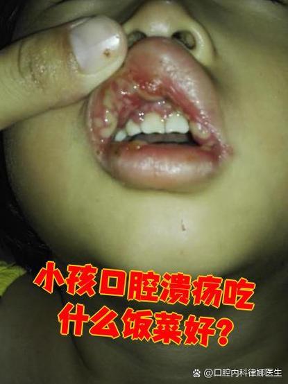 小孩满嘴口腔溃疡发烧是何原因?