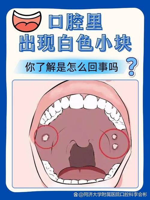 口腔内壁白色凸起是何问题？