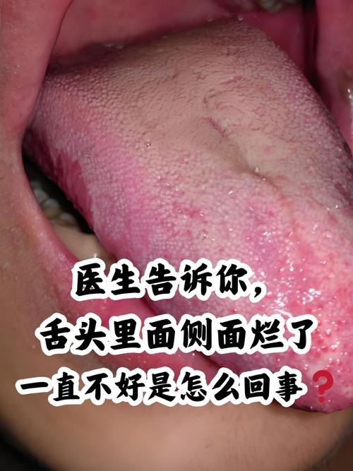 舌根溃疡反复发作是啥原因?