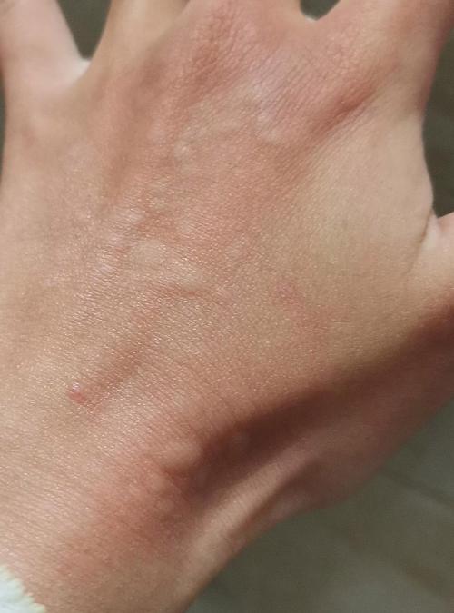 手一抓就起红疙瘩是过敏还是皮肤问题?