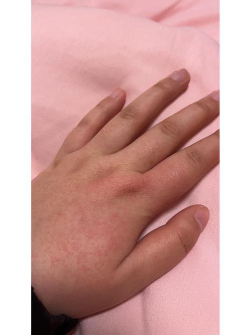 手一抓就起红疙瘩是过敏还是皮肤问题？