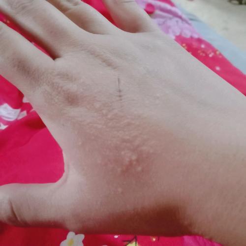 手一抓就起红疙瘩是过敏还是皮肤问题?