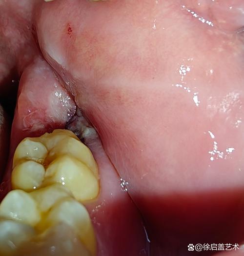 拔完牙食物进牙洞怎么办?