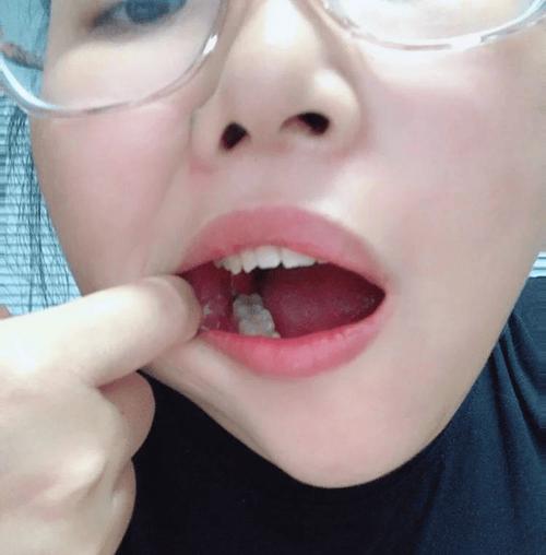 拔完牙食物进牙洞怎么办?