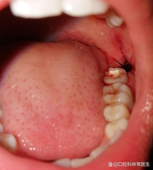 拔完牙食物进牙洞怎么办？