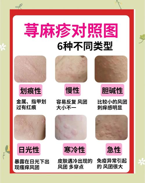 荨麻疹会传染吗?