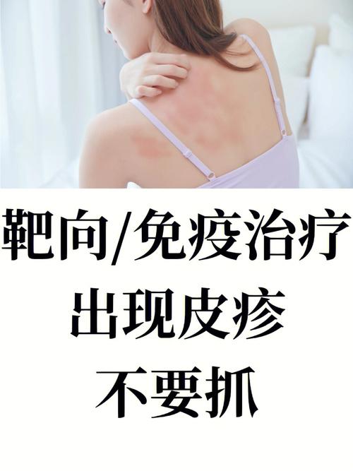 靶向药皮肤痒,如何缓解才安全?